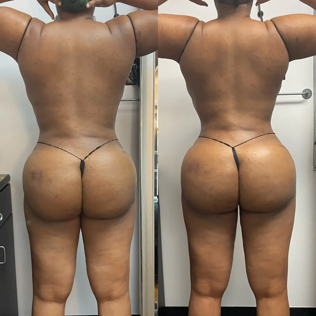 Before and after post-op lymphatic drainage following a BBL, back view: lower back and hips smoother