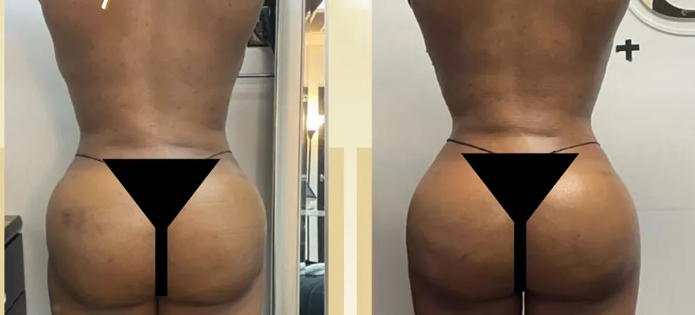 Before and after post-op lymphatic drainage following a BBL, back view: bruising on the hips cleared