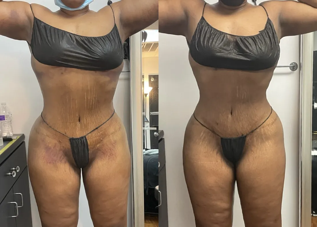 Before and after post-op lymphatic drainage following a BBL, front view: bruising faded and waist narrower