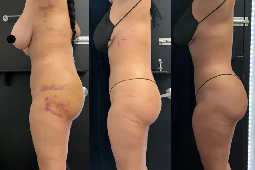 Side view progress after liposuction with post-op lymphatic drainage: heavy bruising and swelling, then smooth contour