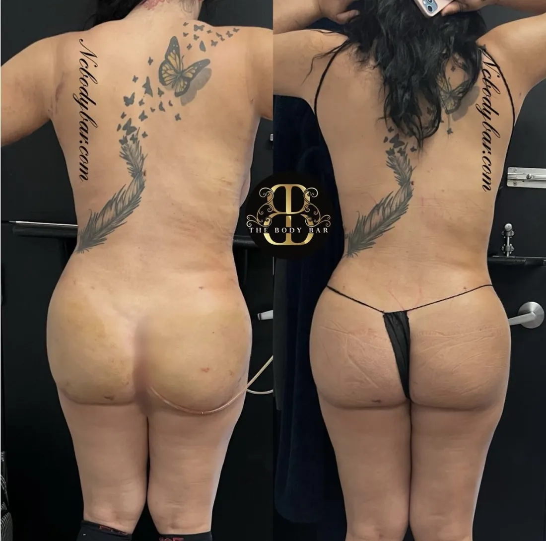 Before and after post-op lymphatic drainage following a BBL, back view: flanks and lower back smoother and less swollen