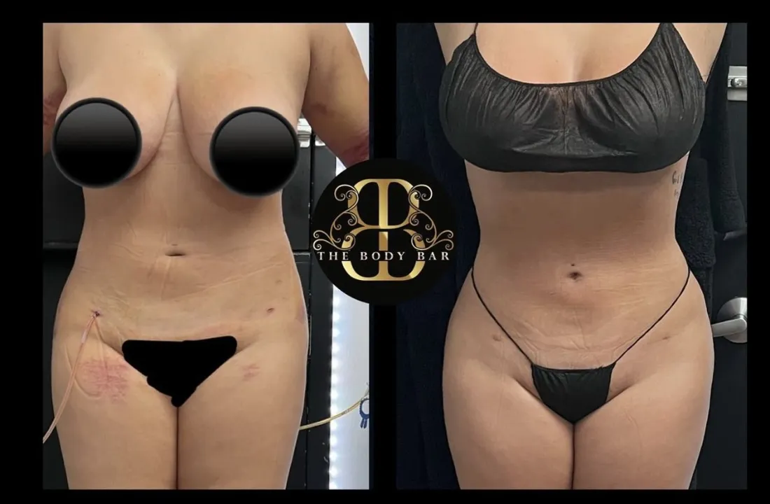 Before and after post-op lymphatic drainage following liposuction, front view: swelling and puffiness gone, waist clearly defined