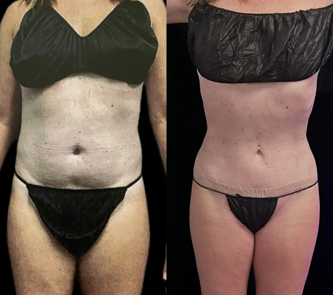 Before and after post-op lymphatic drainage following liposuction of the abdomen and flanks, front view