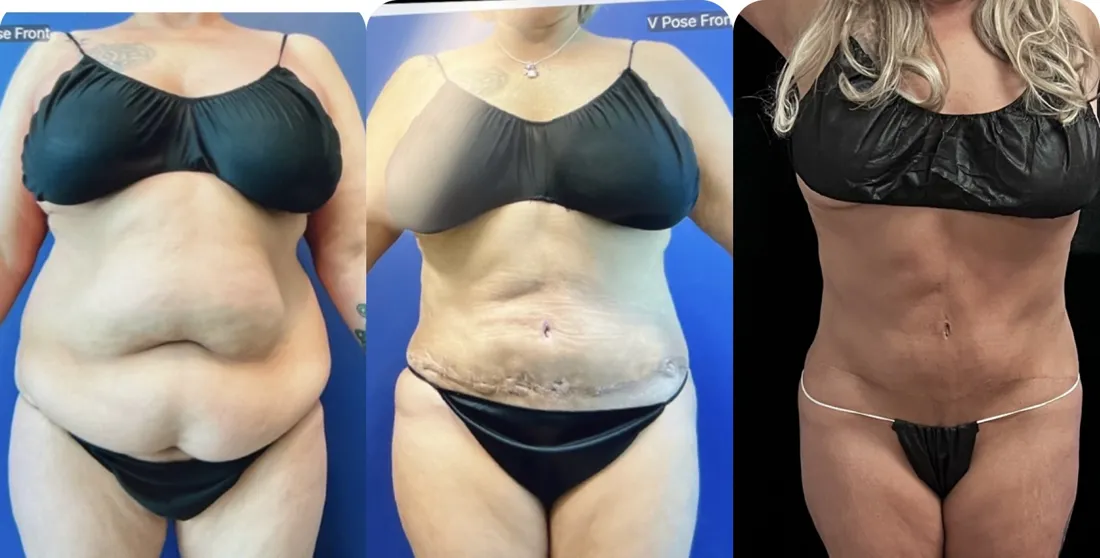 Three stage tummy tuck recovery progress with post-op lymphatic massage: before surgery, swollen after surgery, and final flat result
