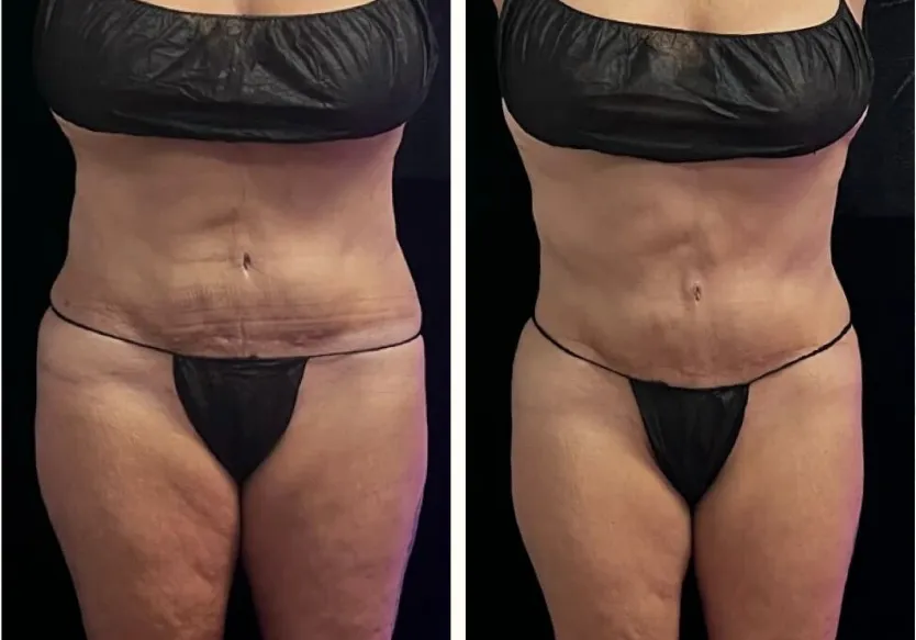 Before and after post-op lymphatic massage following a tummy tuck, front view: abdomen flatter and less swollen above the scar